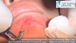 เทคนิคดูแลแผลเป็นตุ่มนูนจากสิว Papular acne scar ที่จมูก + คาง ด้วย Fractional Discovery Picosecond Laser + Deep Focused Ablative Laser