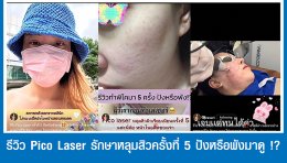 รีวิว Pico Laser รักษาหลุมสิวครั้งที่ 5 ปังหรือพังมาดู !?