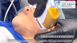 แนะนำเทคนิคยกกระชับผิว ด้วยพลังงานคลื่นเสียง MMFU Focused Ultrasound โปรแกรม Ultraformer MPT