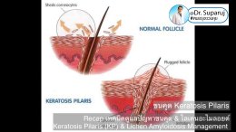  Recap เทคนิคดูแลปัญหาขนคุด & ไลเคนอะไมลอยด์ Keratosis Pilaris (KP) & Lichen Amyloidosis Management