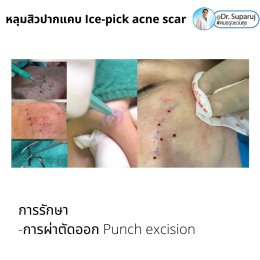  แนะนำเทคนิครักษาหลุมสิวจิกลึก Ice Pick Acne Scar ด้วยเทคนิคเลเซอร์ UltraDeep Pico Technique (Ice Pick Acne Scar Treatment with Discovery Pico Laser + UltraDeep Pico Technique)