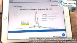 Update เทคโนโลยีใหม่ เทคนิคการรักษาหลุมสิว เม็ดสี & จุดเด่นที่น่าสนใจของ Discovery PICO Laser Derm