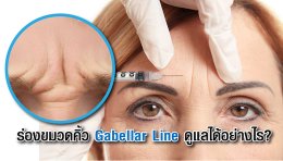 ร่องขมวดคิ้ว Gabellar Line ดูแลได้อย่างไร?