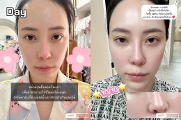 ขอบคุณคุณจูน @jirasuri มากนะครับที่ไว้วางใจให้หมอได้ดูแลปัญหาเรื่องรูขุมขนและจุดด่างดำด้วย โปรแกรม LaserME ครับผม