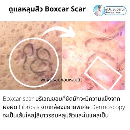 แนะนำเทคนิคดูแลหลุมสิว: เทคนิค Deep Focused Ablative Laser (DFA) ดูแลหลุมสิวลึกขอบชัดพังผืดหนา Boxcar Scar และหลุมสิวลักษณะเส้นยาว Linear scar