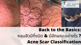 Back to the Basics: หลุมสิวมีกี่ชนิด & มีลักษณะอย่างไร ? Acne Scar Classification Full Clip คลิปเต็ม Facebook/ YouTube Dr. Suparuj หมอรุจชวนคุย ครับ