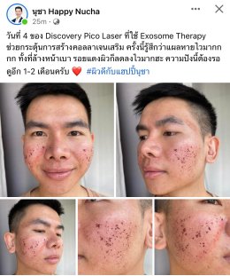 Update รักษาหลุมสิวด้วยเทคนิคการตัดพังผืด Blunt Blade Subcision (Blunt Blade Subcision for Acne Scar Fibrosis Treatment)