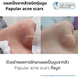 เทคนิคดูแลแผลเป็นตุ่มนูนจากสิว Papular acne scar ที่จมูก + คาง ด้วย Fractional Discovery Picosecond Laser + Deep Focused Ablative Laser