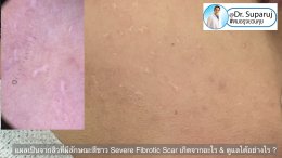 แผลเป็นจากสิวที่มีลักษณะสีขาว severe fibrotic acne scar เกิดจากอะไร & ดูแลได้อย่างไร ?