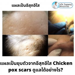 แผลเป็นยุบตัวจากอีสุกอีใส Chicken pox scars ดูแลได้อย่างไร ?