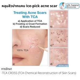  แนะนำเทคนิครักษาหลุมสิวจิกลึก Ice Pick Acne Scar ด้วยเทคนิคเลเซอร์ UltraDeep Pico Technique (Ice Pick Acne Scar Treatment with Discovery Pico Laser + UltraDeep Pico Technique)