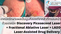  แนะนำเทคนิคดูแลแผลเป็นนูนคีลอยด์: รักษาแผลเป็นนูนคีลอยด์จากสิวที่กรอบหน้าด้วยเทคนิค Discovery Picosecond Laser + Fractional Ablative Laser + LADD Laser-Assisted Drug Delivery