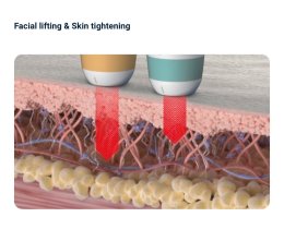 แนะนำนวัตกรรมยกกระชับผิวด้วยพลังงานคลื่นเสียง Hyperthermia Lifting Therapy: Ultraformer MPT Micro-Pulse Technology