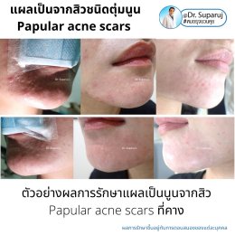 เทคนิคดูแลแผลเป็นตุ่มนูนจากสิว Papular acne scar ที่จมูก + คาง ด้วย Fractional Discovery Picosecond Laser + Deep Focused Ablative Laser