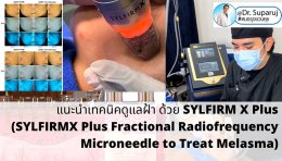 แนะนำเทคนิคดูแลฝ้า ด้วย SYLFIRM X Plus (SYLFIRMX Plus Fractional Radiofrequency Microneedle to Treat Melasma)