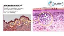 แนะนำเทคนิครักษาหลุมสิว: หัวยิงพิเศษรักษาหลุมสิว Fractional MLA 8 mm. ของ Discovery Pico Laser