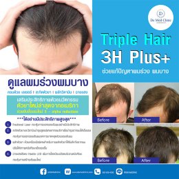 Triple Hair 3H Plus ดูแลผมร่วงผมบาง ครบด้วย เลเซอร์ l สะกิดตัวยา | ผลักวิตามิน | ฉายแสง