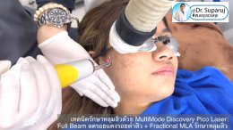 เทคนิครักษาหลุมสิวด้วย MultiMode Discovery Pico Laser: Full Beam ลดรอยแดงรอยดำสิว + Fractional MLA รักษาหลุมสิวครับ