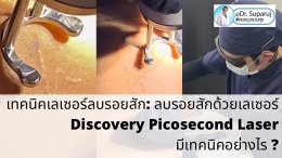 แนะนำเทคนิคเลเซอร์ลบรอยสักด้วย Picosecond Laser: ลบรอยสักด้วยเลเซอร์ Discovery Picosecond Laser มีเทคนิคอย่างไร ?