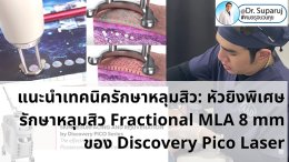 แนะนำเทคนิครักษาหลุมสิว: หัวยิงพิเศษรักษาหลุมสิว Fractional MLA 8 mm. ของ Discovery Pico Laser