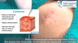 ฉีดสิวแล้วเป็นรอยบุ๋มยุบตัว เกิดจากอะไรดูแลได้อย่างไรบ้าง ?  (Skin atrophy after intralesional steroid injection for nodulocystic acne treatment )