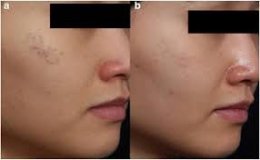 เทคนิครักษากระโฮริ กระลึก ปานโฮริ (Hori's nevus) ด้วยเลเซอร์ Discovery Picosecond Laser