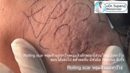 Back to the Basics: หลุมสิวมีกี่ชนิด & มีลักษณะอย่างไร ? Acne Scar Classification Full Clip คลิปเต็ม Facebook/ YouTube Dr. Suparuj หมอรุจชวนคุย ครับ