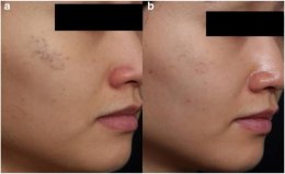 เทคนิครักษากระโฮริ กระลึก ปานโฮริ (Hori's nevus) ด้วยเลเซอร์ Discovery Picosecond Laser