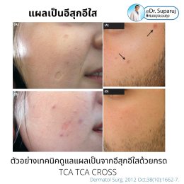 แผลเป็นยุบตัวจากอีสุกอีใส Chicken pox scars ดูแลได้อย่างไร ?