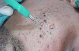 แผลเป็นจากสิวที่มีลักษณะสีขาว severe fibrotic acne scar เกิดจากอะไร & ดูแลได้อย่างไร ?