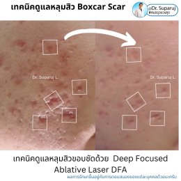 แนะนำเทคนิคดูแลหลุมสิว: เทคนิค Deep Focused Ablative Laser (DFA) ดูแลหลุมสิวลึกขอบชัดพังผืดหนา Boxcar Scar และหลุมสิวลักษณะเส้นยาว Linear scar