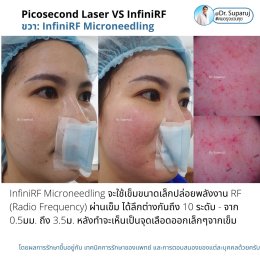 แนะนำเทคนิครักษาหลุมสิว: ดูแลหลุมสิวด้วยเข็มพลังงานคลื่นวิทยุ Infini RF Microneedle