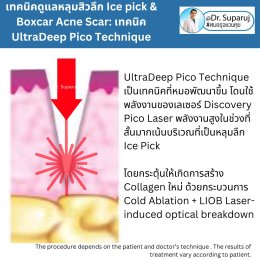  แนะนำเทคนิครักษาหลุมสิวจิกลึก Ice Pick Acne Scar ด้วยเทคนิคเลเซอร์ UltraDeep Pico Technique (Ice Pick Acne Scar Treatment with Discovery Pico Laser + UltraDeep Pico Technique)