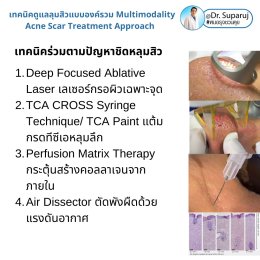 มีปัญหาหลุมสิว แต่ยังมีสิวขึ้นอยู่ สามารถรักษาหลุมสิวได้เลยไหม หรือควรดูแลอย่างไร?