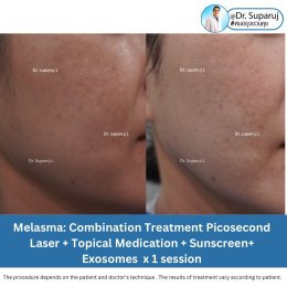 Exosomes มีบทบาทและกลไกในการดูแลฝ้า หรือไม่ & กลไกลเป็นอย่างไร ?