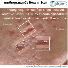 แนะนำเทคนิคดูแลหลุมสิว: เทคนิค Deep Focused Ablative Laser (DFA) ดูแลหลุมสิวลึกขอบชัดพังผืดหนา Boxcar Scar และหลุมสิวลักษณะเส้นยาว Linear scar