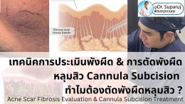 เทคนิคการประเมินพังผืด และการตัดพังผืดหลุมสิว Cannula Subcision ทำไมต้องตัดพังผืดรักษาหลุมสิว ?  (Acne Scar Fibrosis Evaluation & Cannula Subcision Treatment)