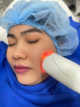 โปรแกรม PORA COOL + Skin Radiant Treatment โพล่าร์คูล + สกินเรเดียน ทรีทเมนท์ หน้ากระจ่างใส ลดการอักเสบของผิว ลดสิว