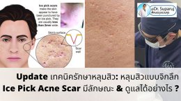 Update เทคนิครักษาหลุมสิว: หลุมสิวแบบจิกลึก Ice Pick Acne Scar มีลักษณะ & ดูแลได้อย่างไร ?