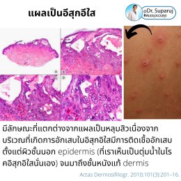 แผลเป็นยุบตัวจากอีสุกอีใส Chicken pox scars ดูแลได้อย่างไร ?