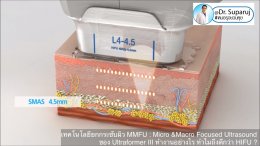 เทคโนโลยียกกระชับผิว MMFU : Micro &Macro Focused Ultrasound ของ Ultraformer III ทำงานอย่างไร ทำไมถึงดีกว่า HIFU ?
