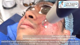 เทคนิครักษาหลุมสิวด้วยหลายเทคนิคเสริมร่วมกัน Multimodality Acne Scar Treatment Approach: Cannula Subcision + InfiniRF Microneedle + Discovery Pico Laser + Exosome