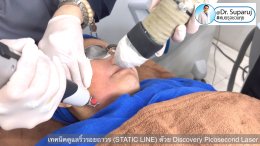 เทคนิคดูแลริ้วรอยถาวร (STATIC LINE) ด้วย Discovery Picosecond Laser