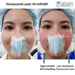 แนะนำเทคนิครักษาหลุมสิว: ดูแลหลุมสิวด้วยเข็มพลังงานคลื่นวิทยุ Infini RF Microneedle