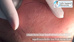 Back to the Basics: หลุมสิวมีกี่ชนิด & มีลักษณะอย่างไร ? Acne Scar Classification Full Clip คลิปเต็ม Facebook/ YouTube Dr. Suparuj หมอรุจชวนคุย ครับ