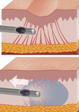 Update เทคนิค Subcision ตัดพังผืดรักษาหลุมสิว Acne Scar Subcision Techniques