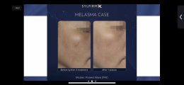 แนะนำเทคนิคดูแลฝ้า ด้วย SYLFIRM X Plus (SYLFIRMX Plus Fractional Radiofrequency Microneedle to Treat Melasma)