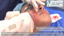 เทคนิครักษาหลุมสิวด้วยหลายเทคนิคเสริมร่วมกัน Multimodality Acne Scar Treatment Approach: Cannula Subcision + InfiniRF Microneedle + Discovery Pico Laser + Exosome
