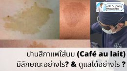 ปานสีกาแฟใส่นม (Café au lait) มีลักษณะอย่างไร? & ดูแลได้อย่างไร ?