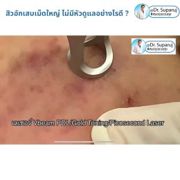 มีสิวอักเสบเม็ดใหญ่ ไม่มีหัว ขึ้น ดูแลอย่างไรดี ?